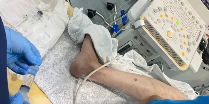 В Ханты-Мансийске врачи спасли от ампутации единственную ногу пациента