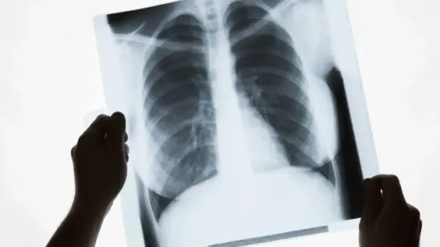 Югра присоединилась к всероссийской акции: как вовремя выявить рак лёгких