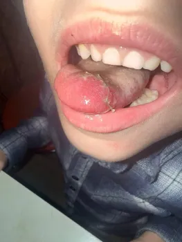 В Сургуте ребенок едва не остался без языка после посещения картинга